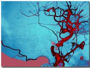 Blocked Vein Brain Burst Aneurysm Cerebral Blood