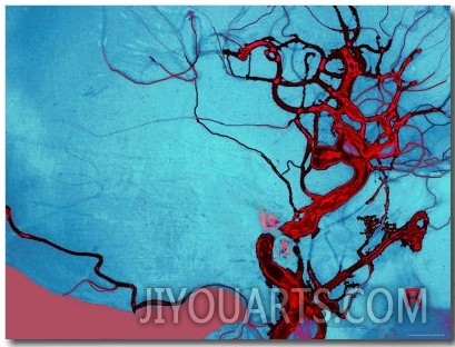Blocked Vein Brain Burst Aneurysm Cerebral Blood